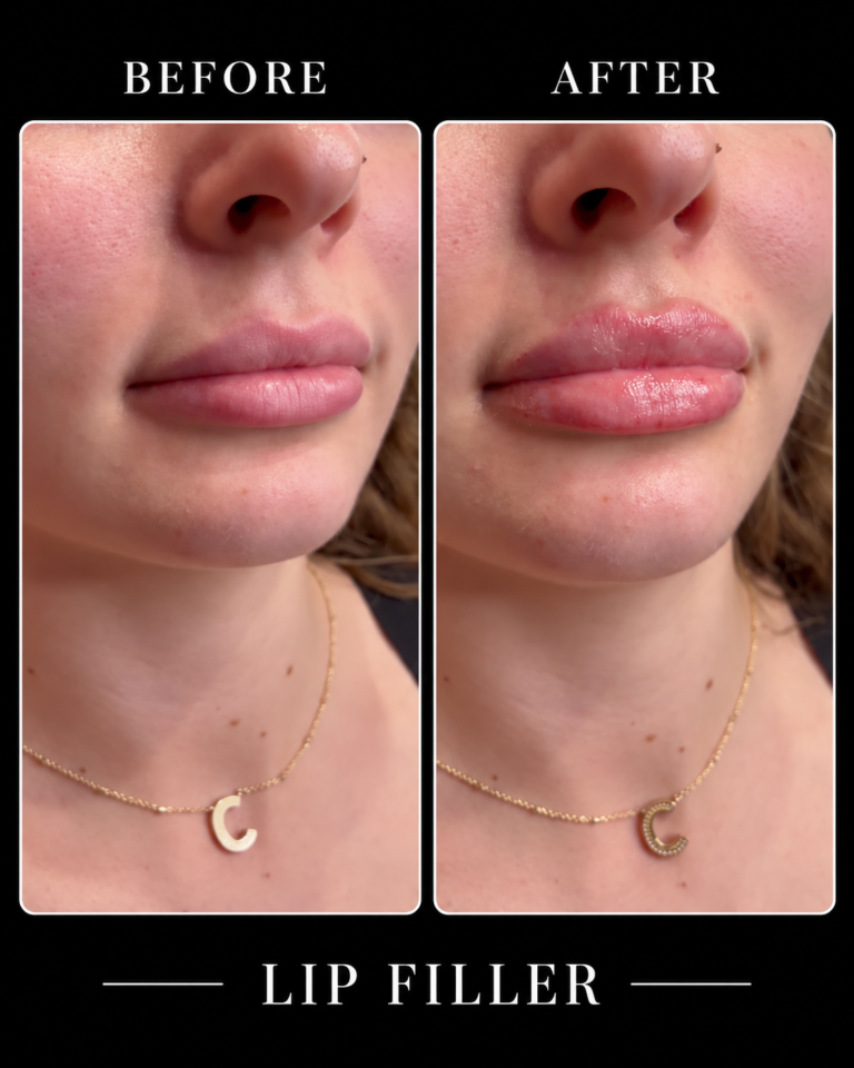 GlowGetter_Lip_Filler_Before_After