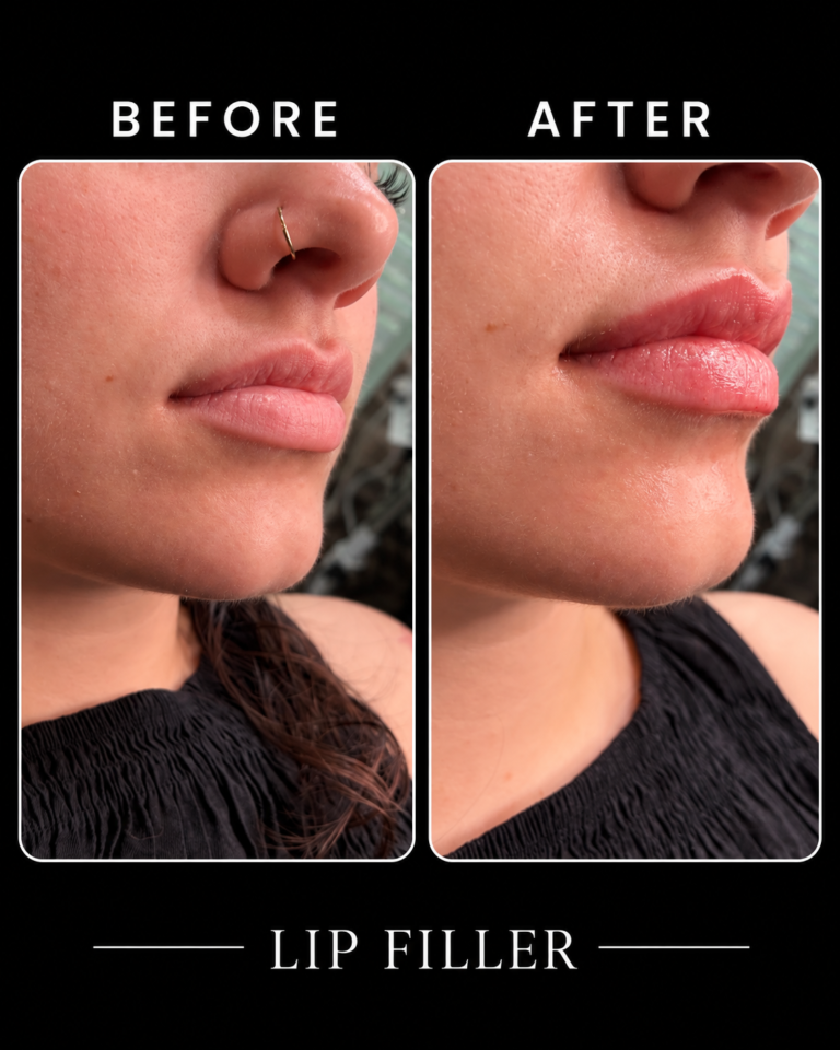 before_after_lip_filler