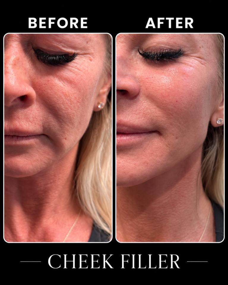cheek_filler_before_and_after